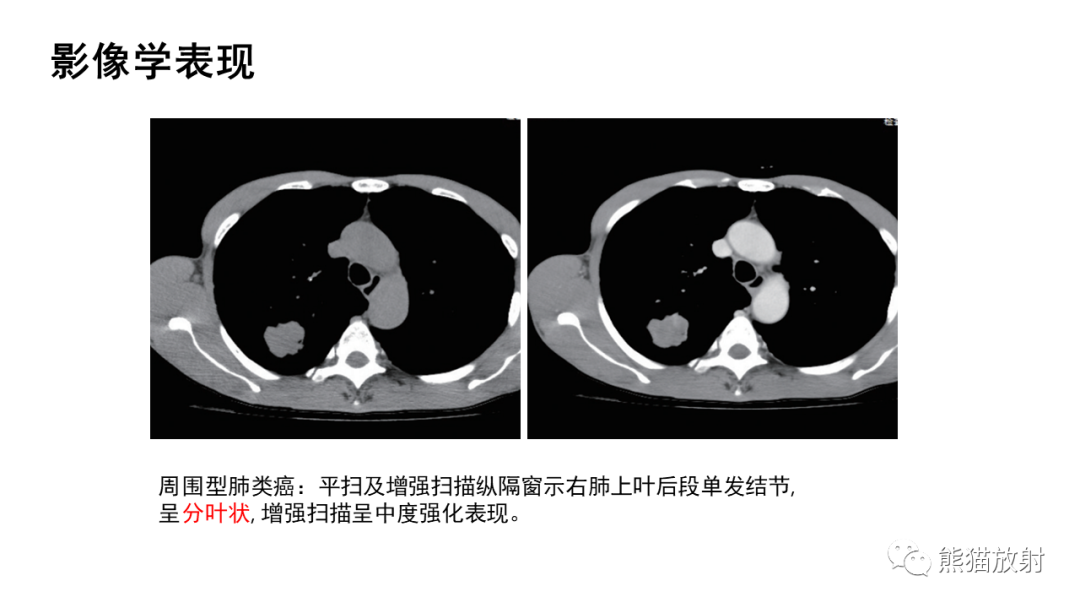 影像PPT - 【病例】肺典型类癌 VS 不典型类癌-27