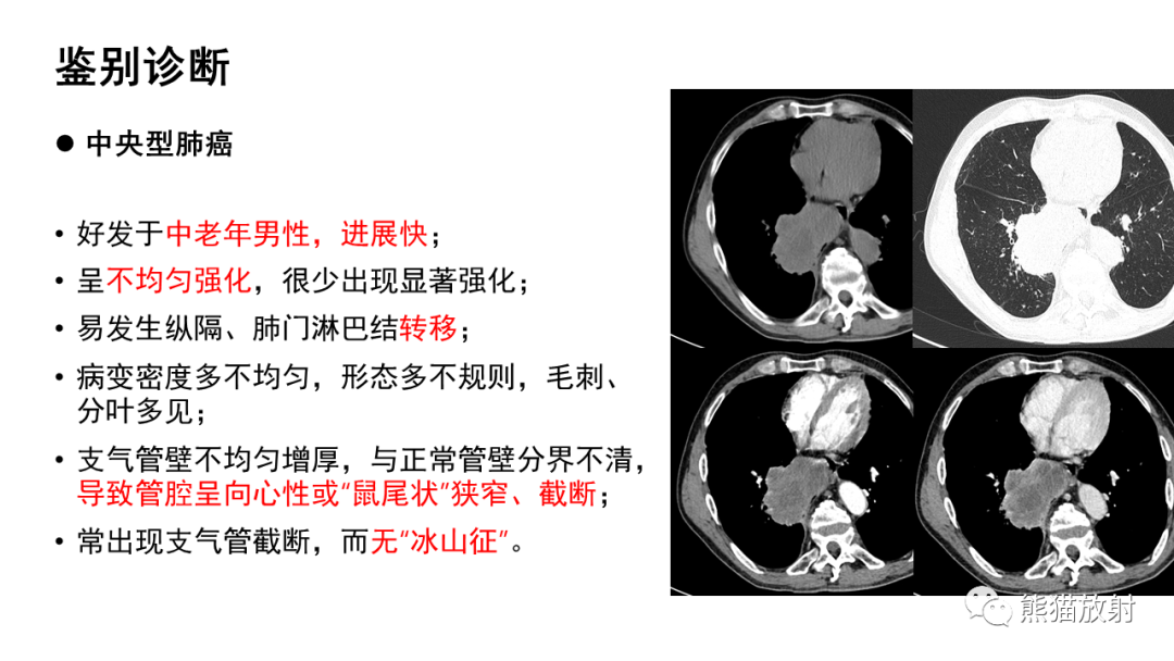 影像PPT - 【病例】肺典型类癌 VS 不典型类癌-30