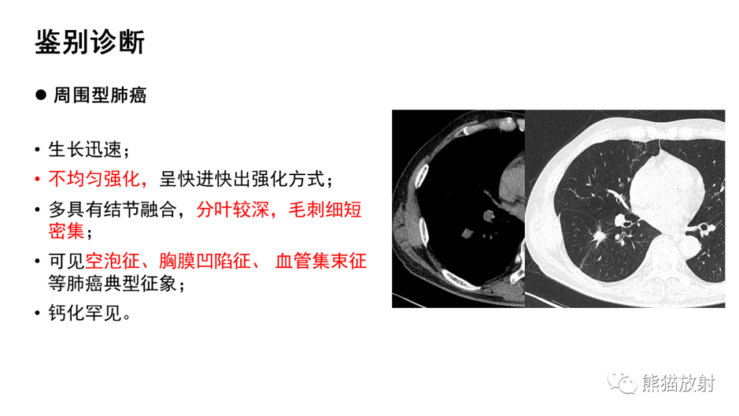 影像PPT - 【病例】肺典型类癌 VS 不典型类癌-31