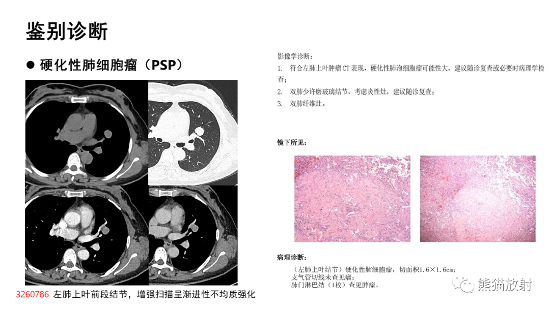 影像PPT - 【病例】肺典型类癌 VS 不典型类癌-33