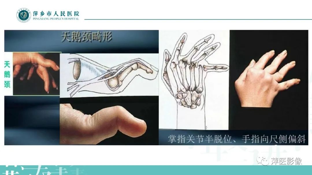 影像PPT - 【PPT】类风湿关节炎X线诊断及鉴别诊断-5