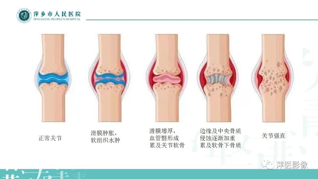 影像PPT - 【PPT】类风湿关节炎X线诊断及鉴别诊断-8
