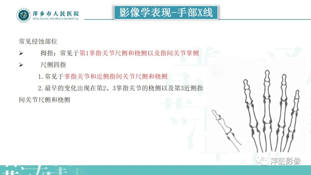 影像PPT - 【PPT】类风湿关节炎X线诊断及鉴别诊断-12