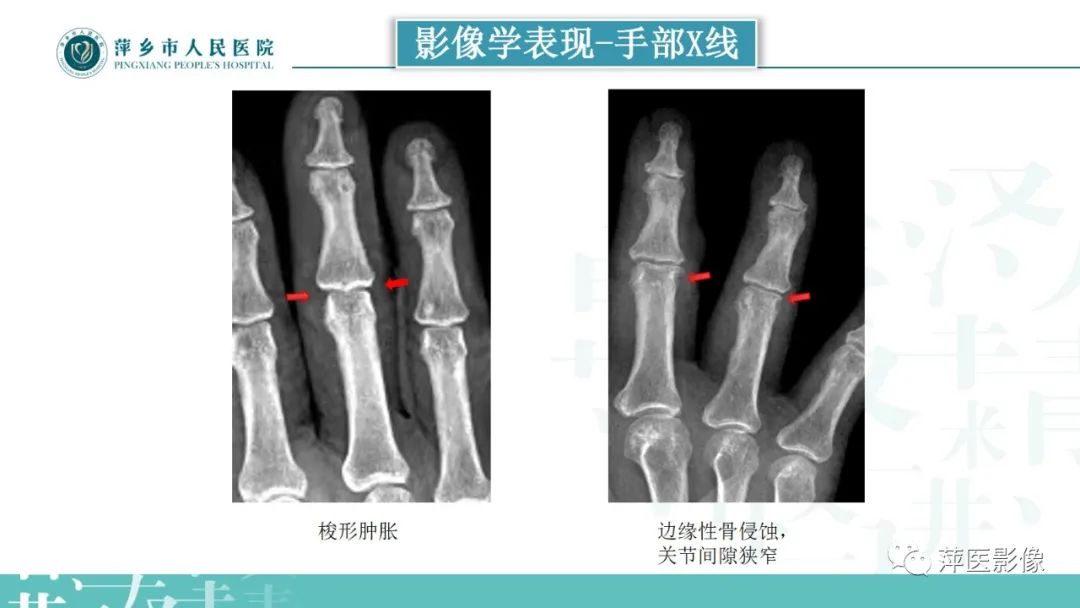 影像PPT - 【PPT】类风湿关节炎X线诊断及鉴别诊断-13