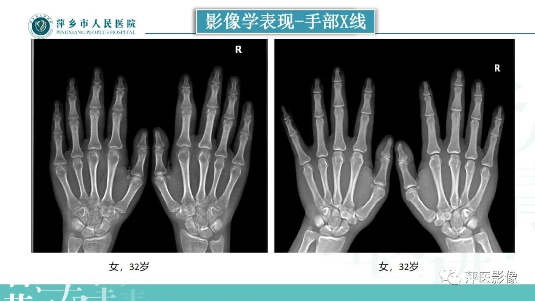 影像PPT - 【PPT】类风湿关节炎X线诊断及鉴别诊断-14