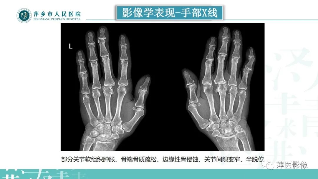 影像PPT - 【PPT】类风湿关节炎X线诊断及鉴别诊断-15