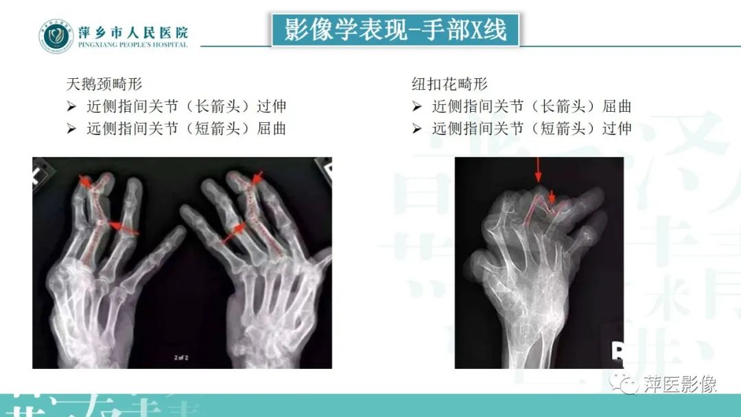 影像PPT - 【PPT】类风湿关节炎X线诊断及鉴别诊断-16