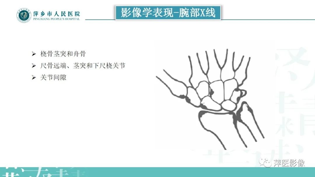 影像PPT - 【PPT】类风湿关节炎X线诊断及鉴别诊断-17
