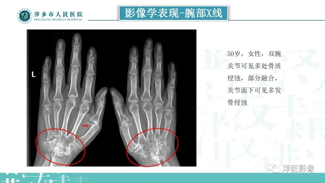 影像PPT - 【PPT】类风湿关节炎X线诊断及鉴别诊断-18