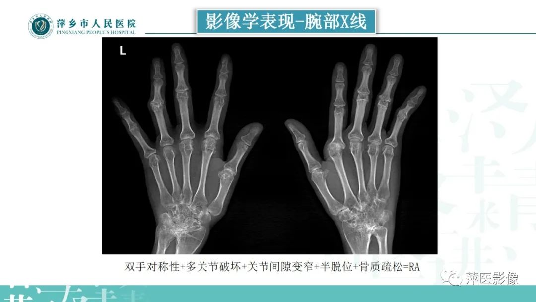 影像PPT - 【PPT】类风湿关节炎X线诊断及鉴别诊断-19