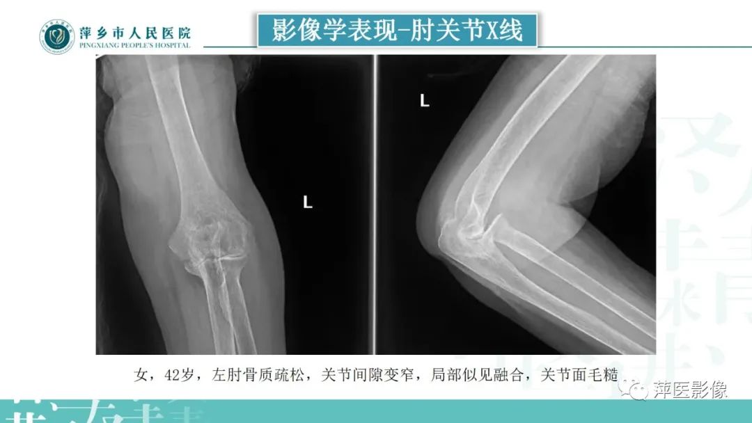 影像PPT - 【PPT】类风湿关节炎X线诊断及鉴别诊断-20