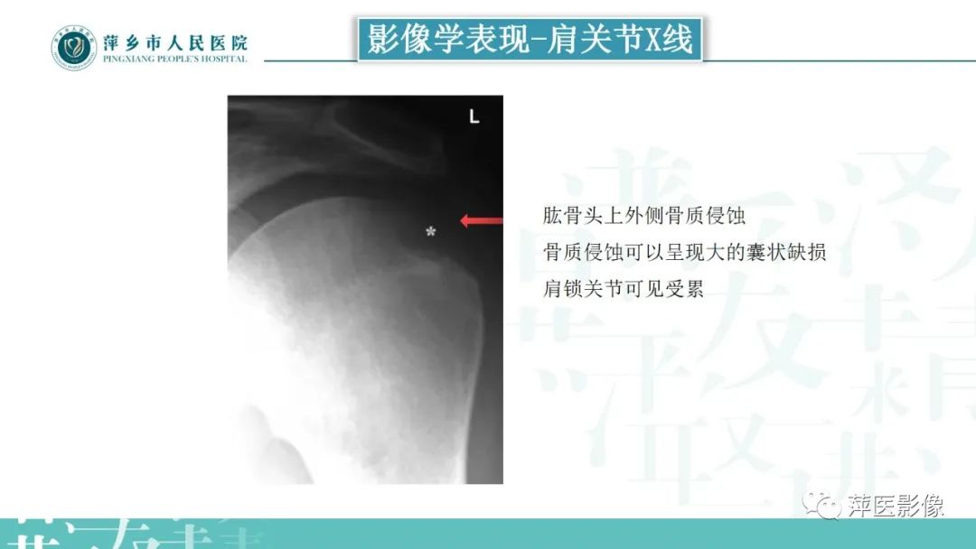 影像PPT - 【PPT】类风湿关节炎X线诊断及鉴别诊断-22