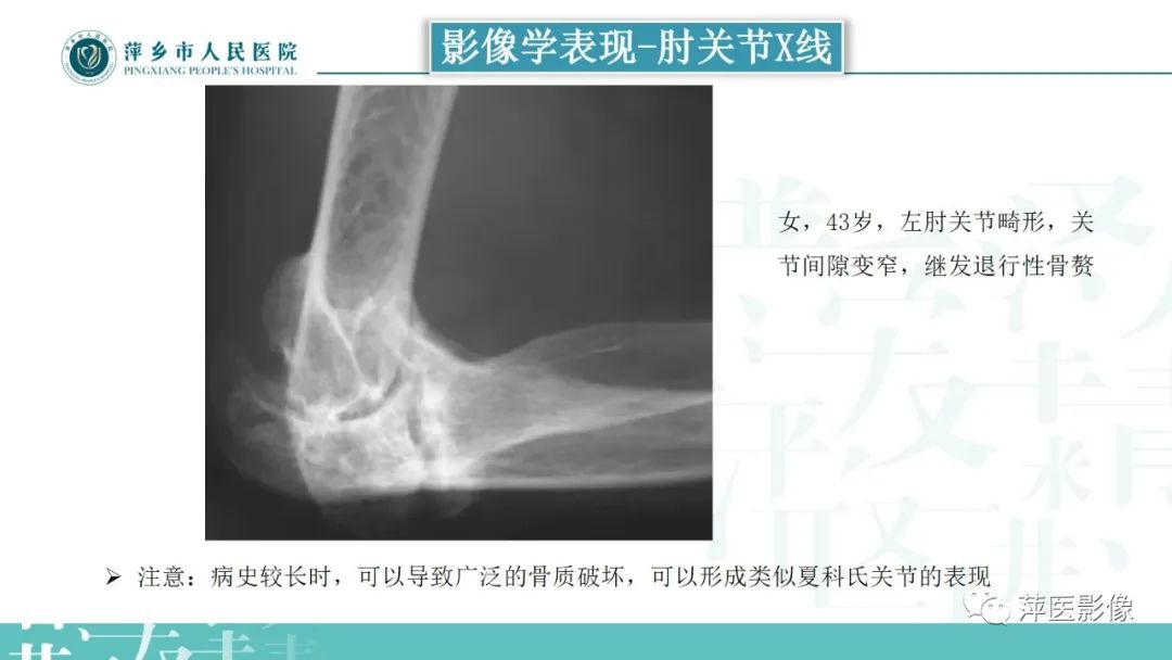 影像PPT - 【PPT】类风湿关节炎X线诊断及鉴别诊断-21
