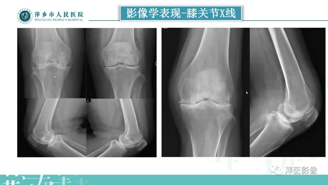 影像PPT - 【PPT】类风湿关节炎X线诊断及鉴别诊断-23