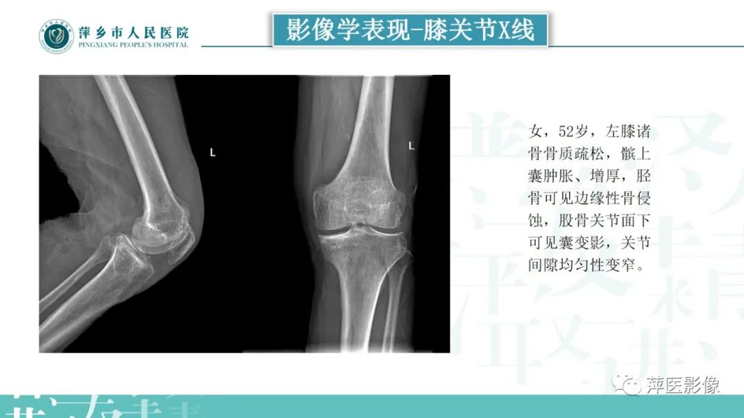 影像PPT - 【PPT】类风湿关节炎X线诊断及鉴别诊断-24