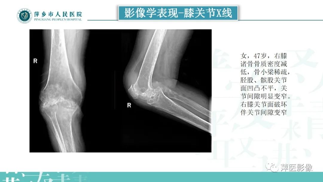影像PPT - 【PPT】类风湿关节炎X线诊断及鉴别诊断-25