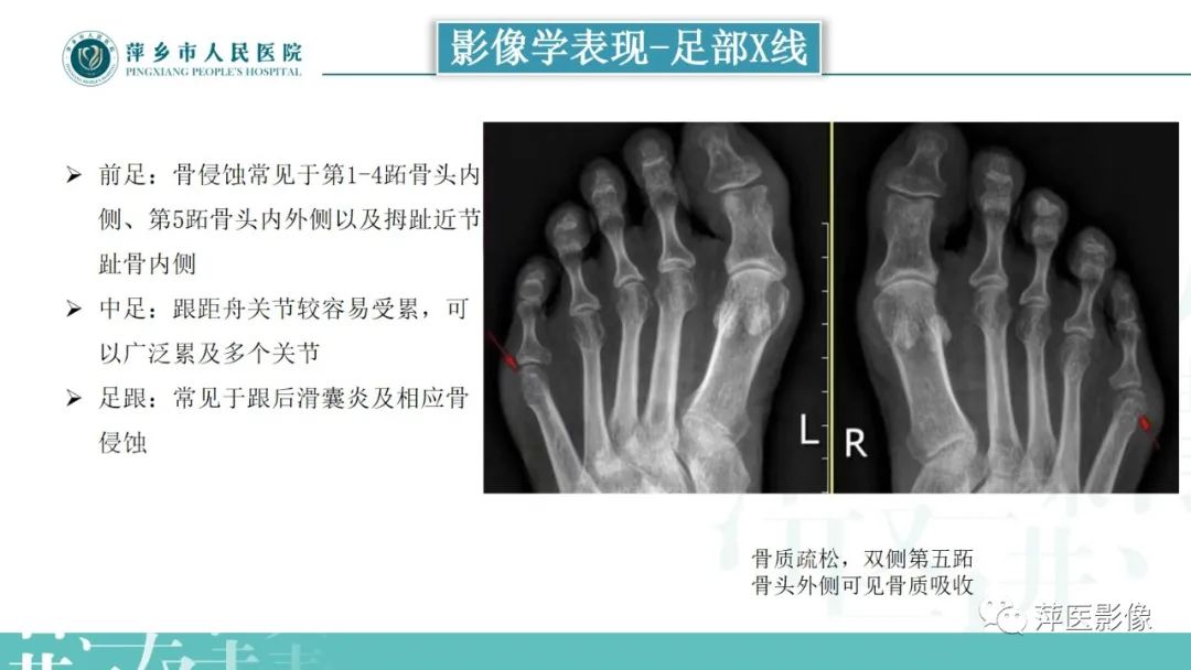 影像PPT - 【PPT】类风湿关节炎X线诊断及鉴别诊断-26