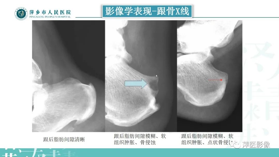 影像PPT - 【PPT】类风湿关节炎X线诊断及鉴别诊断-27