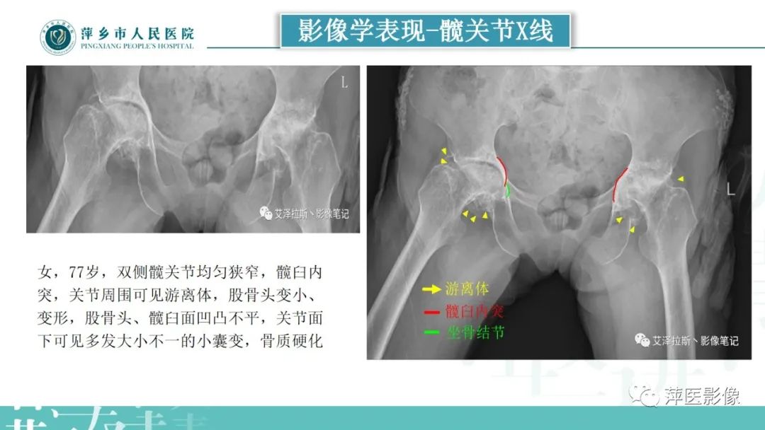 影像PPT - 【PPT】类风湿关节炎X线诊断及鉴别诊断-28