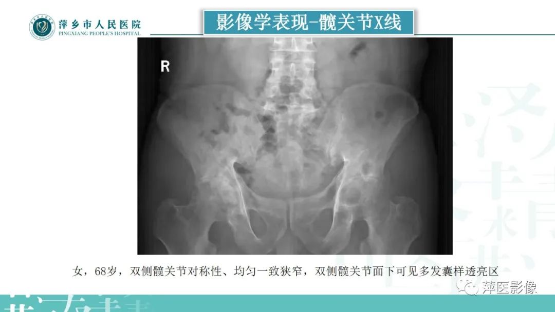 影像PPT - 【PPT】类风湿关节炎X线诊断及鉴别诊断-29