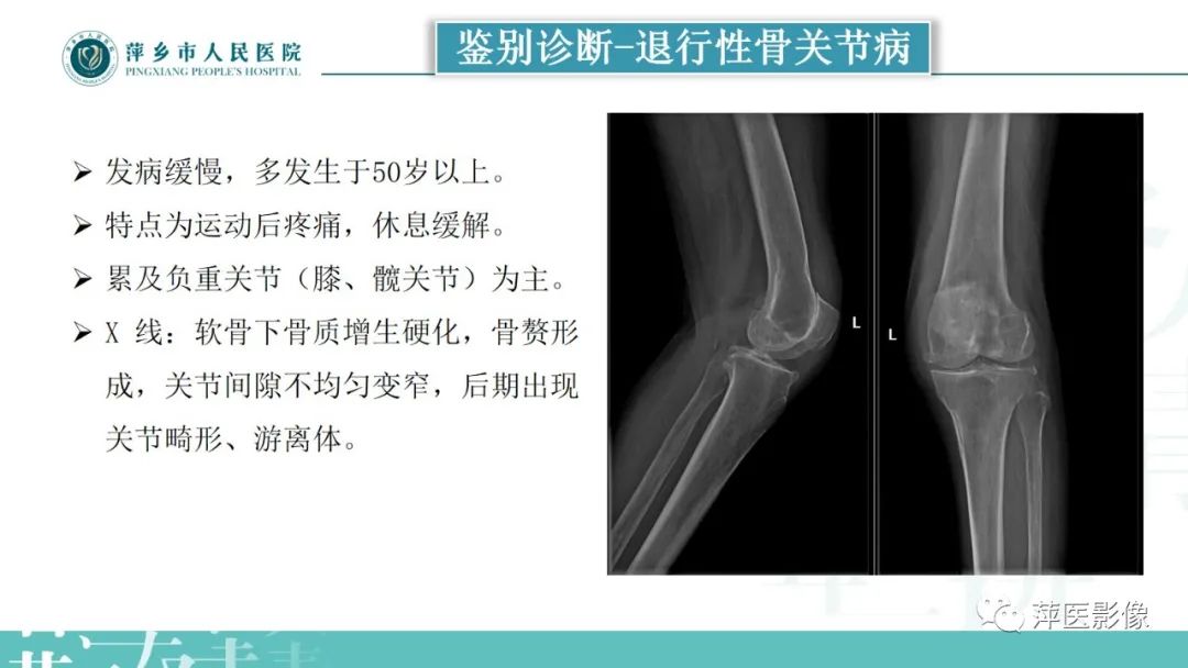 影像PPT - 【PPT】类风湿关节炎X线诊断及鉴别诊断-30