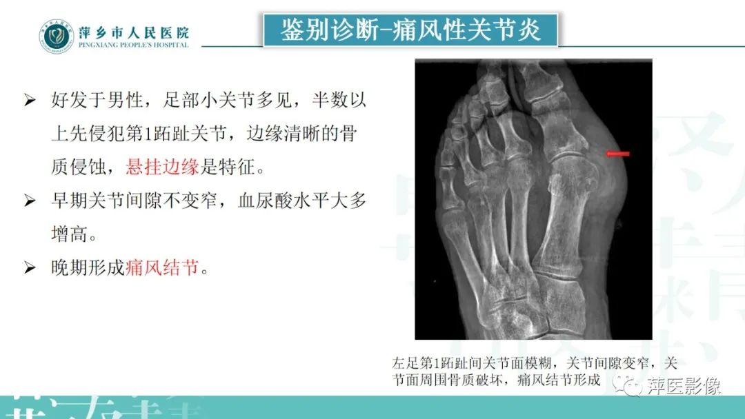 影像PPT - 【PPT】类风湿关节炎X线诊断及鉴别诊断-31
