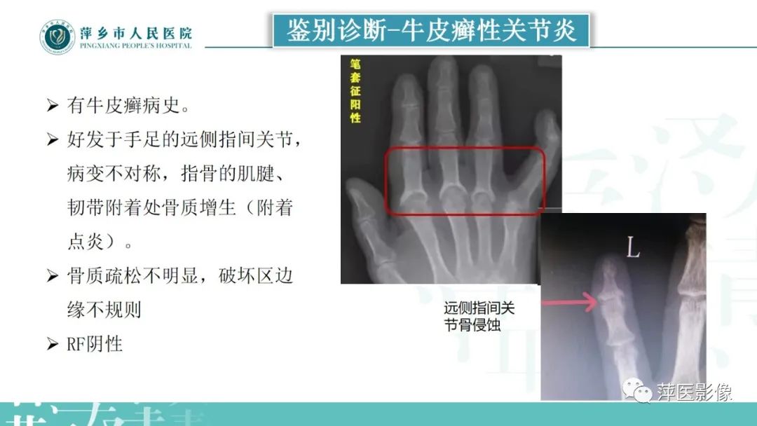 影像PPT - 【PPT】类风湿关节炎X线诊断及鉴别诊断-32