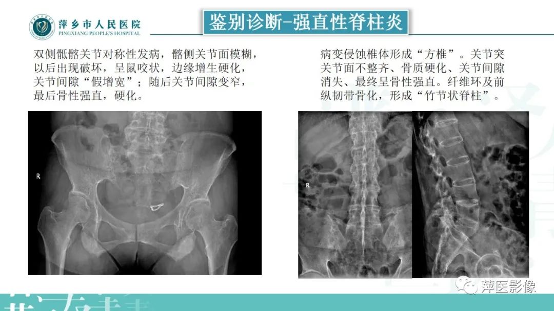 影像PPT - 【PPT】类风湿关节炎X线诊断及鉴别诊断-33