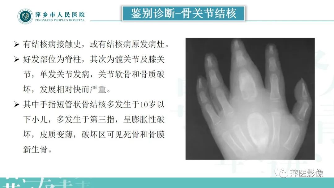 影像PPT - 【PPT】类风湿关节炎X线诊断及鉴别诊断-34