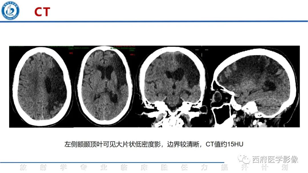 影像PPT - 【PPT】脑皮质层状坏死影像诊断与鉴别-4