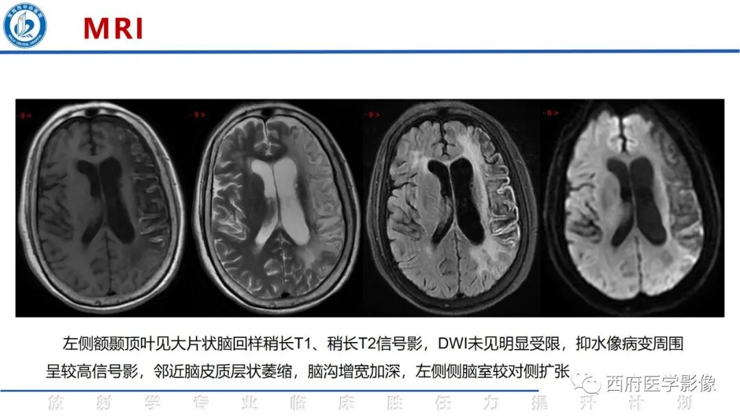 影像PPT - 【PPT】脑皮质层状坏死影像诊断与鉴别-5