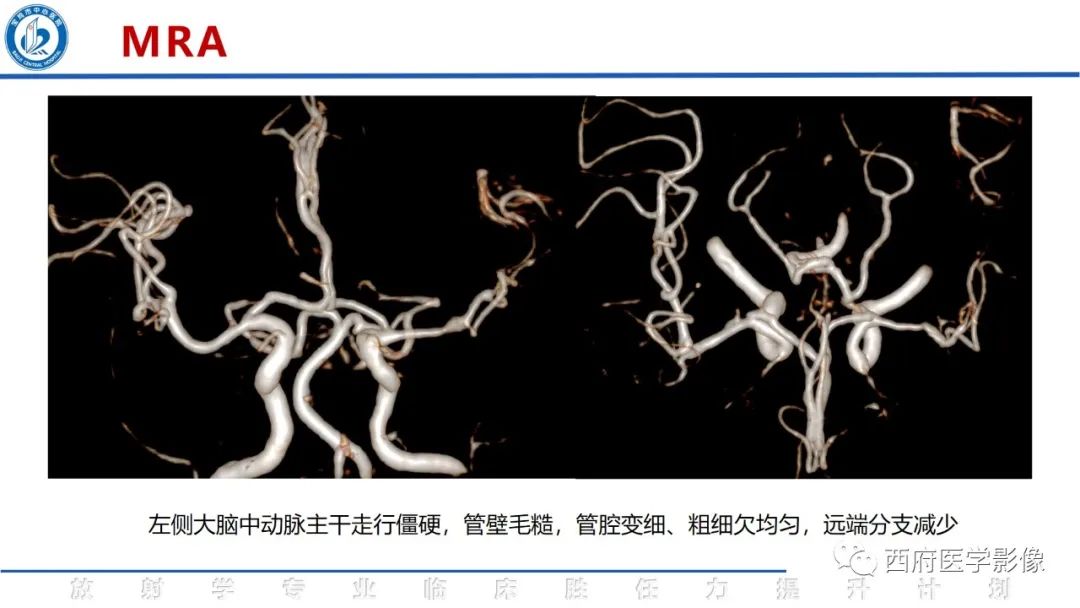 影像PPT - 【PPT】脑皮质层状坏死影像诊断与鉴别-6