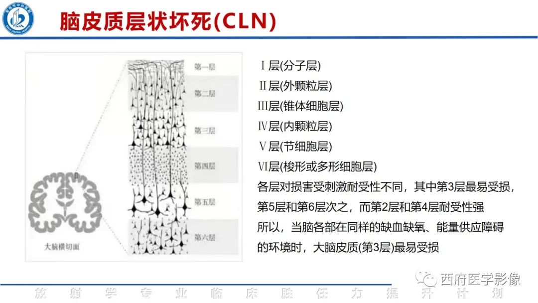 影像PPT - 【PPT】脑皮质层状坏死影像诊断与鉴别-12