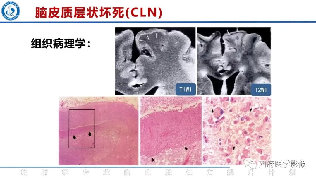 影像PPT - 【PPT】脑皮质层状坏死影像诊断与鉴别-15