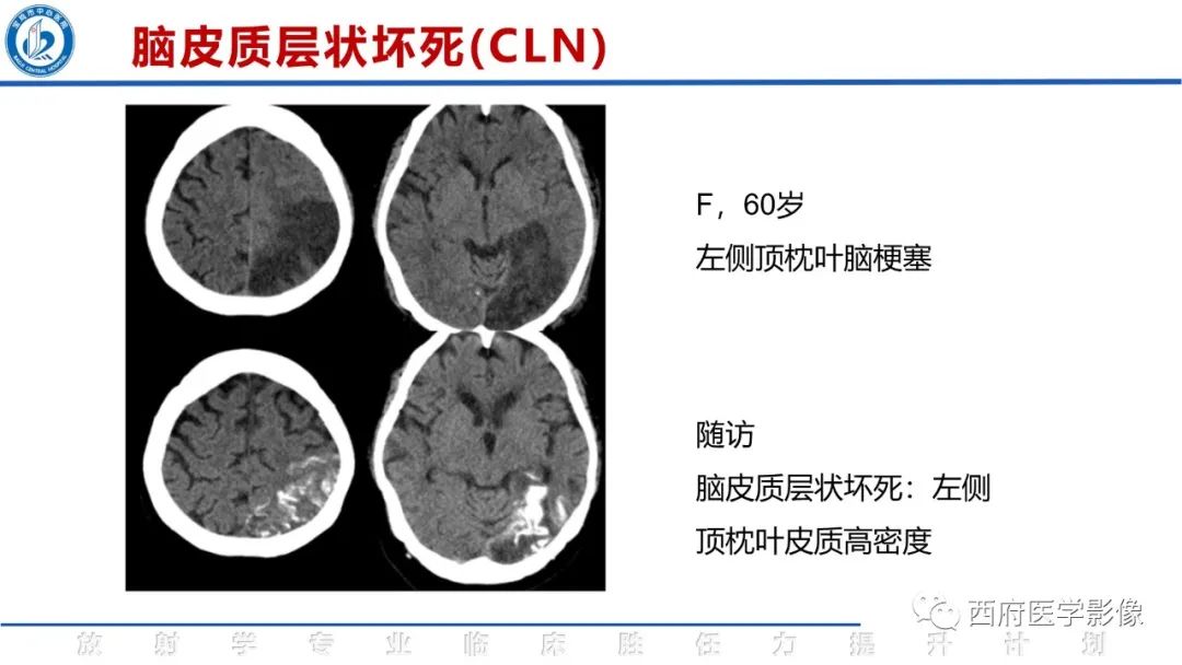 影像PPT - 【PPT】脑皮质层状坏死影像诊断与鉴别-17