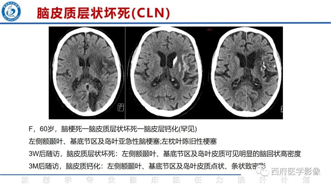 影像PPT - 【PPT】脑皮质层状坏死影像诊断与鉴别-18