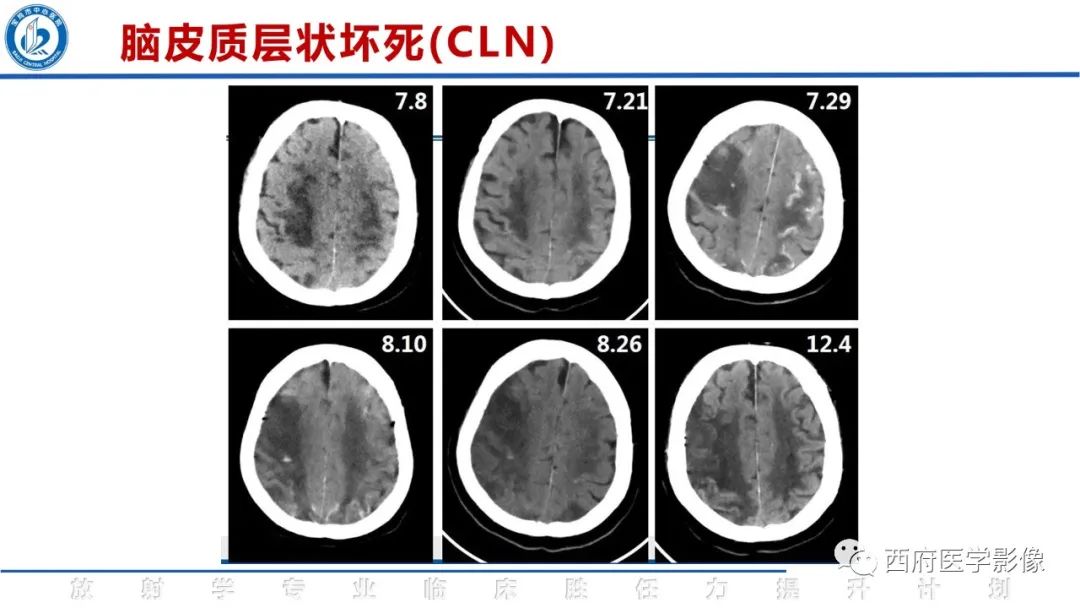 影像PPT - 【PPT】脑皮质层状坏死影像诊断与鉴别-19