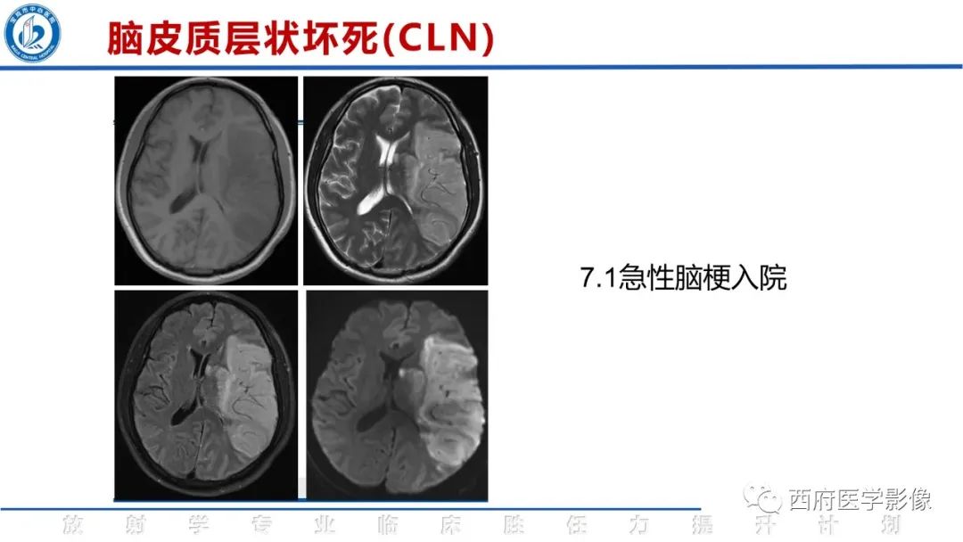 影像PPT - 【PPT】脑皮质层状坏死影像诊断与鉴别-22