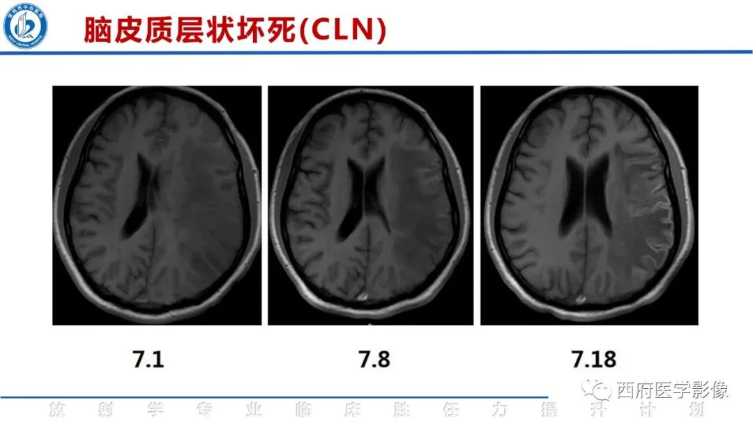影像PPT - 【PPT】脑皮质层状坏死影像诊断与鉴别-23
