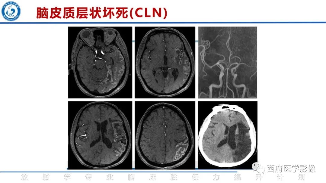 影像PPT - 【PPT】脑皮质层状坏死影像诊断与鉴别-24