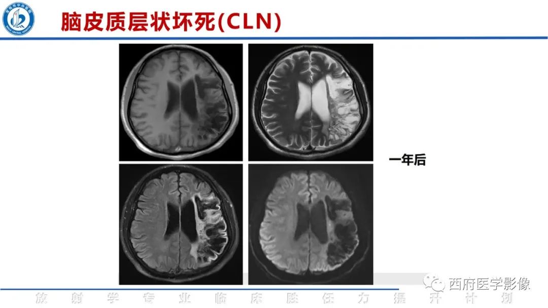 影像PPT - 【PPT】脑皮质层状坏死影像诊断与鉴别-25