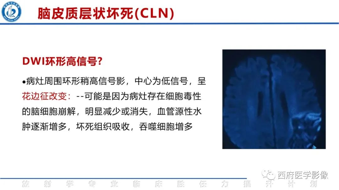 影像PPT - 【PPT】脑皮质层状坏死影像诊断与鉴别-28