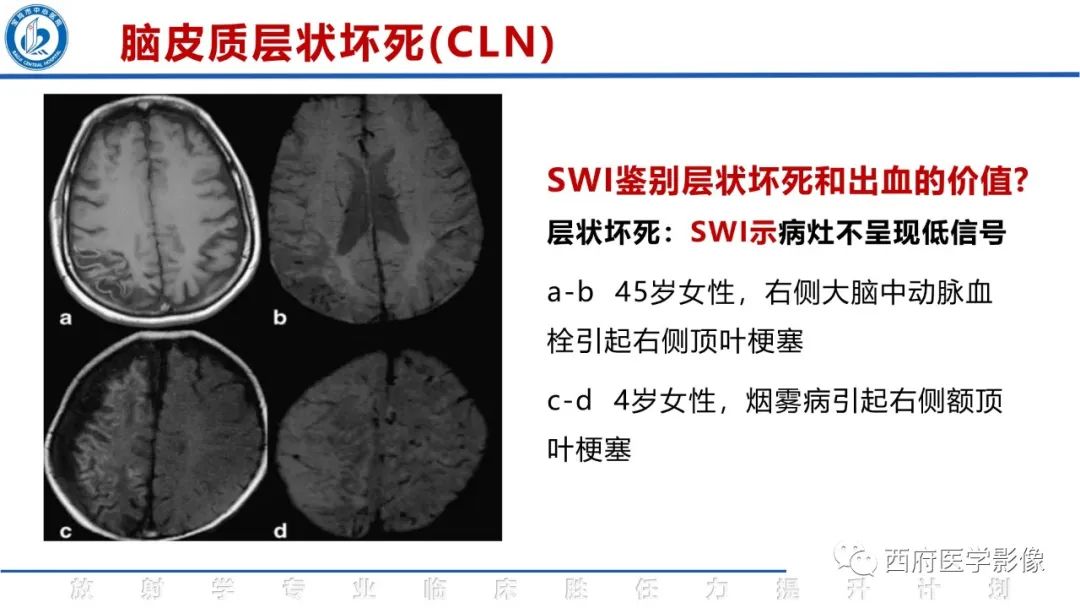 影像PPT - 【PPT】脑皮质层状坏死影像诊断与鉴别-29