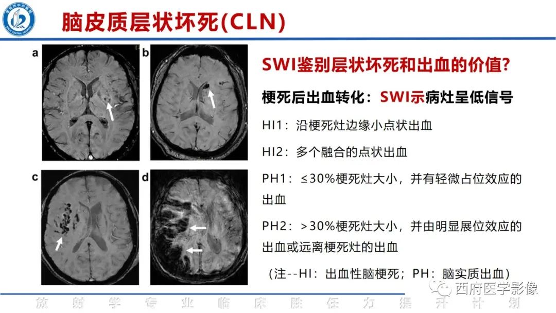 影像PPT - 【PPT】脑皮质层状坏死影像诊断与鉴别-30