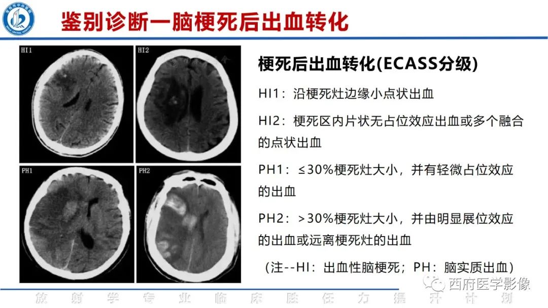 影像PPT - 【PPT】脑皮质层状坏死影像诊断与鉴别-33