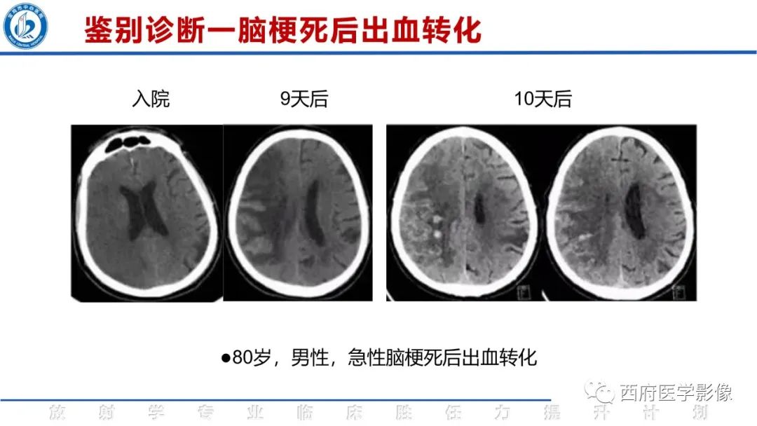 影像PPT - 【PPT】脑皮质层状坏死影像诊断与鉴别-34