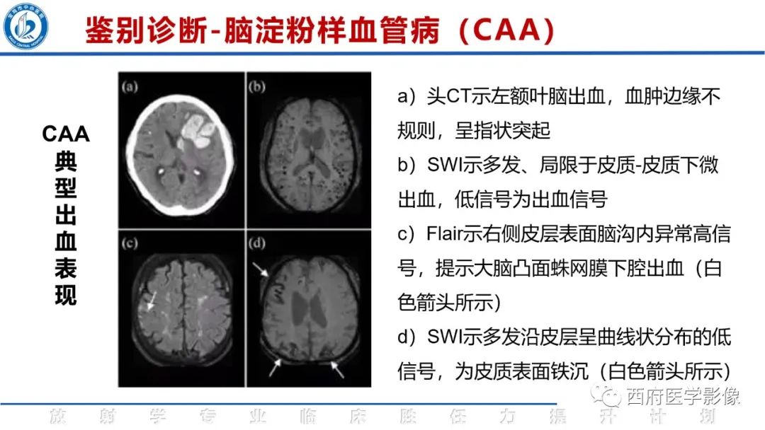 影像PPT - 【PPT】脑皮质层状坏死影像诊断与鉴别-39