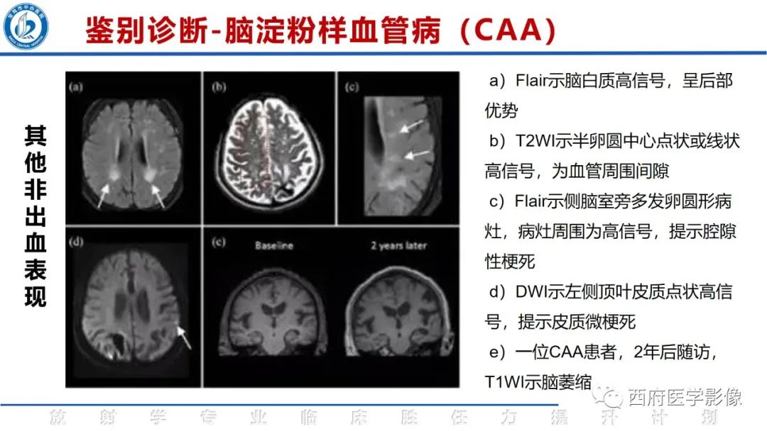 影像PPT - 【PPT】脑皮质层状坏死影像诊断与鉴别-40