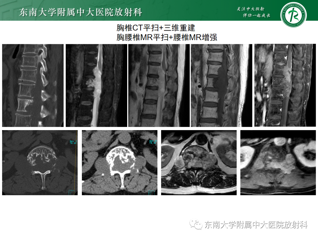 影像PPT - 【PPT】椎管内硬膜外间隙病变-2