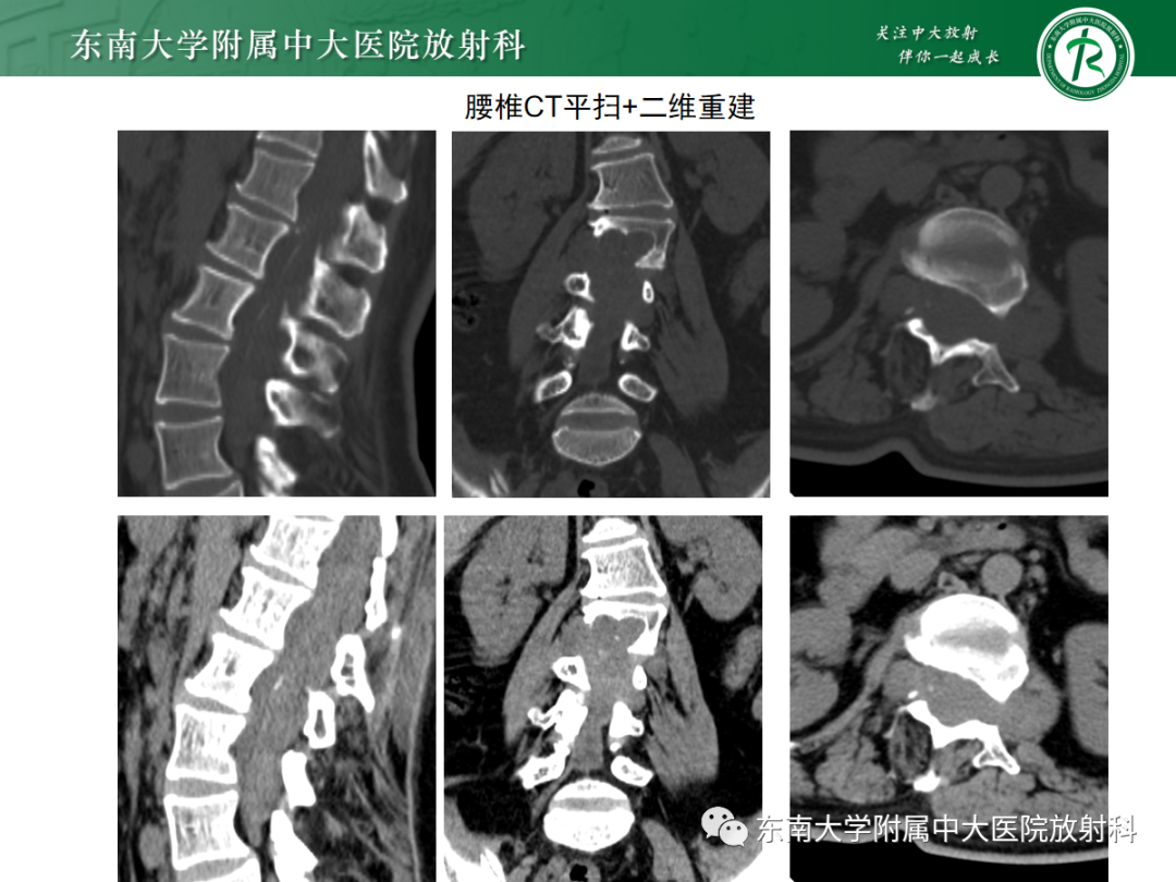 影像PPT - 【PPT】椎管内硬膜外间隙病变-4